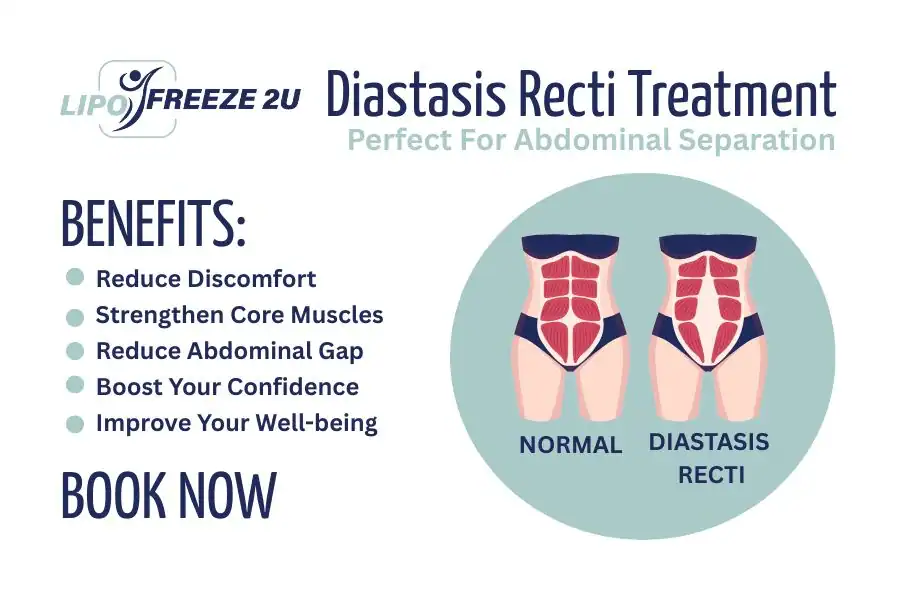 Benefits of body toning treatment Bridgwater for Diastasis recti