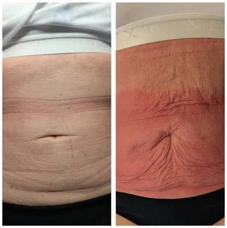 How Does RF Microneedling Improve Crepey, Thin and Uneven Skin Texture Bridgwater?