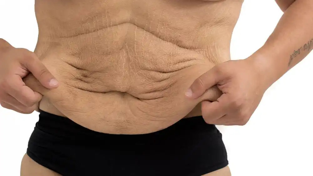 RF Microneedling for Loose Skin: How Can It Help Tighten and Reshape the Skin Bridgwater?
